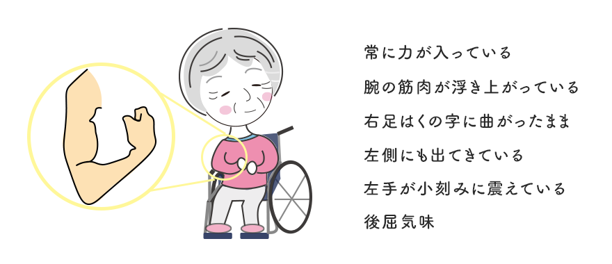 診断されてから6年後のリアル介護記録|母をどんどん苦しめる固縮、ジストニア、安静時振戦